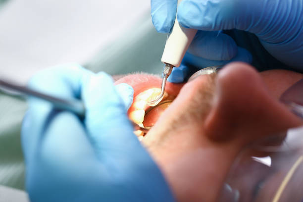 Best Emergency Tooth Extraction in Wellsville, UT
